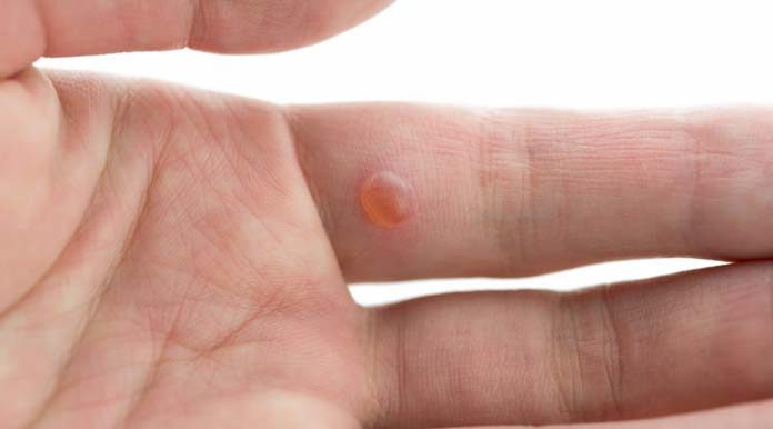 Simpatia-para-tirar-verruga Simpatia para tirar verruga